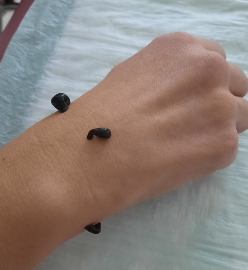 Blutegeltherapie an der Hand