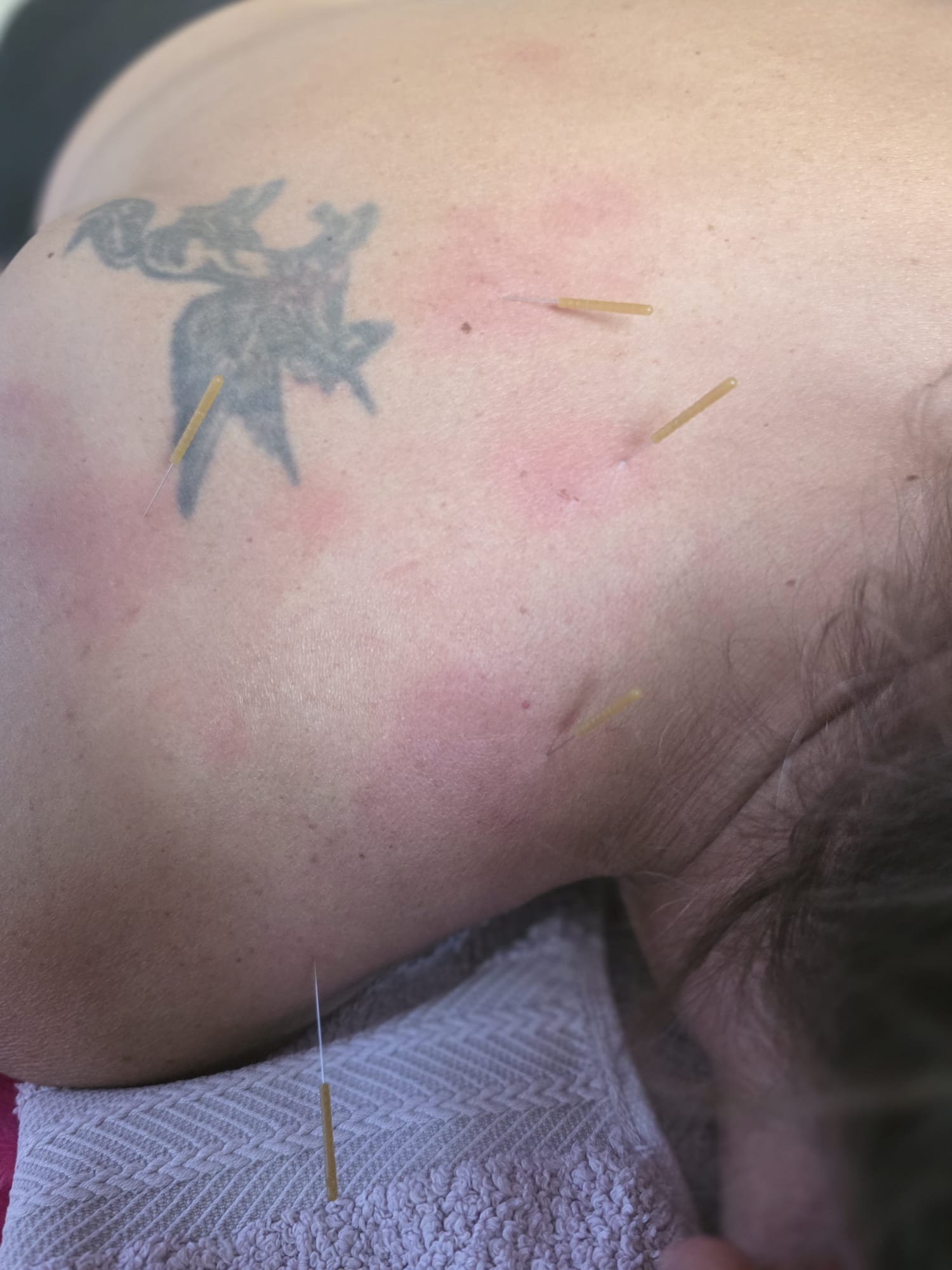 Dry Needling Behandlung